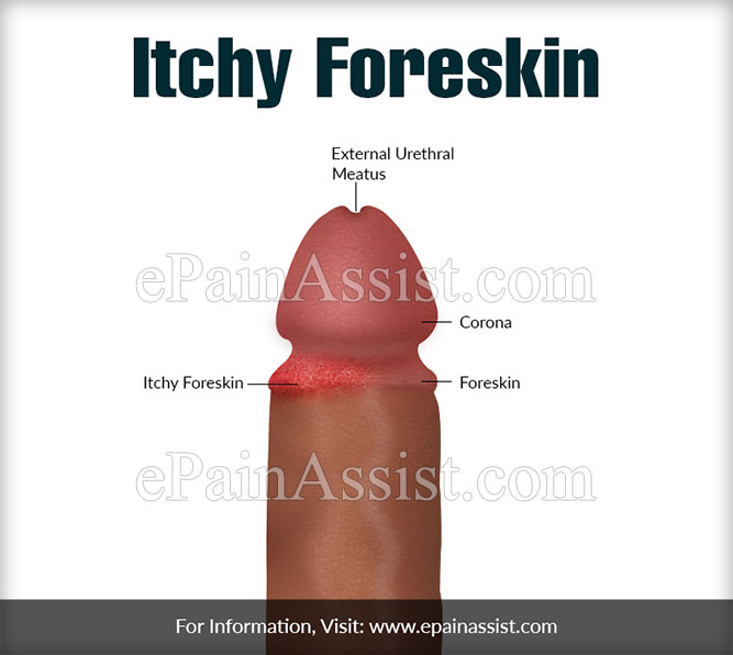 Friction burn on penis