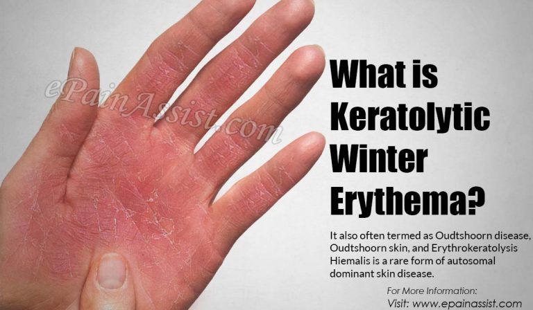 Keratolytic Winter Erythema: Causes, Symptoms, Treatment, Prevention, Risk
