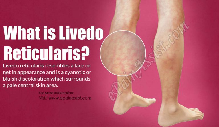 Livedo Reticularis: Causes, Symptoms, Types, Treatment, Prognosis