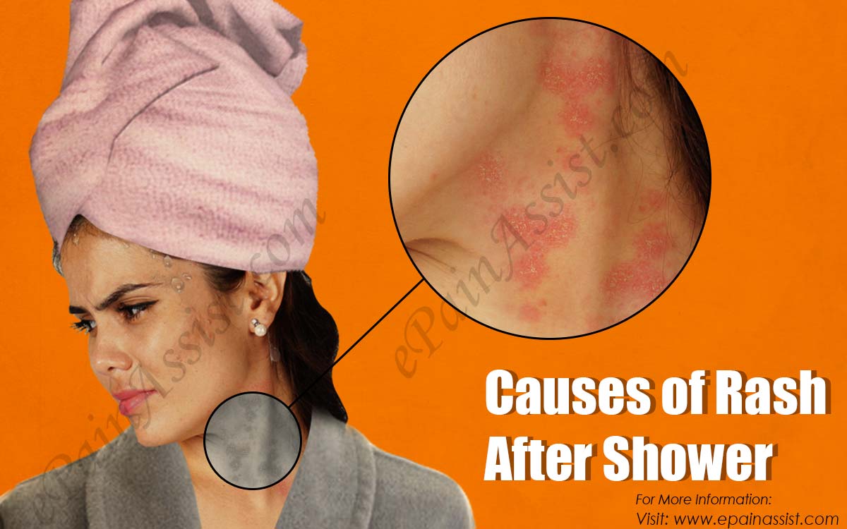 Causes of Rash After Shower