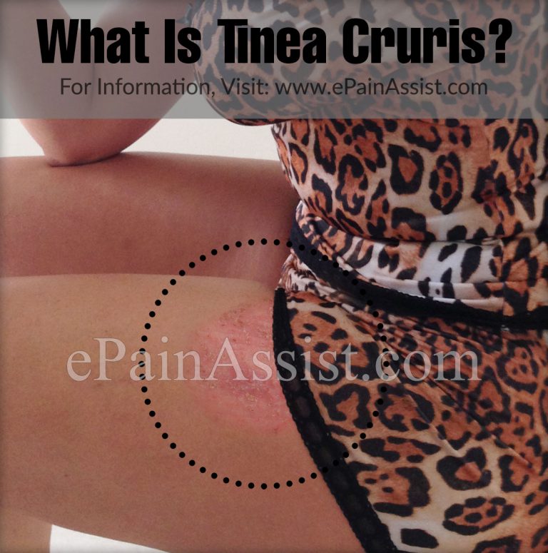 Tinea Cruris or Crotch Itch: Symptoms, Causes, Treatment, Prevention, Diagnosis