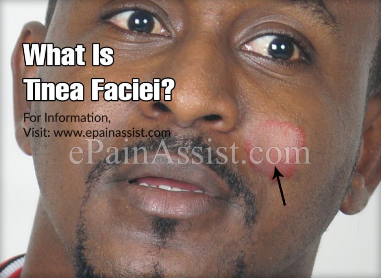 Tinea Faciei: Causes, Symptoms, Treatment, Diagnosis