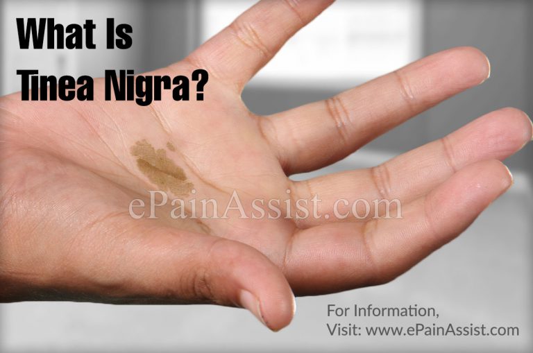 Tinea Nigra: Causes, Symptoms, Treatment, Diagnosis