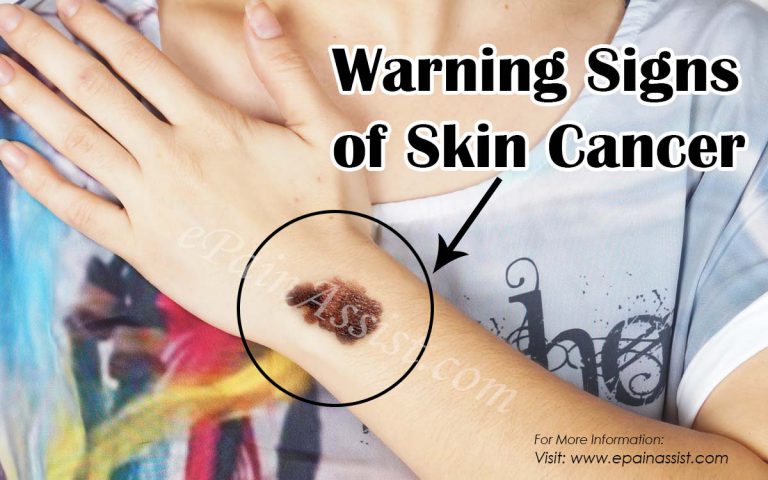 Warning Signs of Skin Cancer