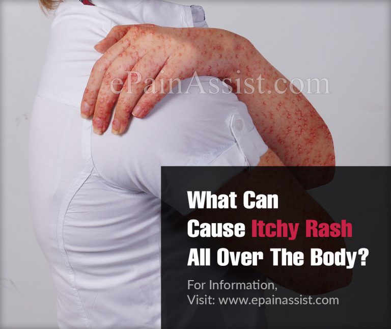 What Can Cause Itchy Rash All Over The Body?