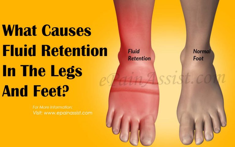 What Causes Fluid Retention In The Legs And Feet?