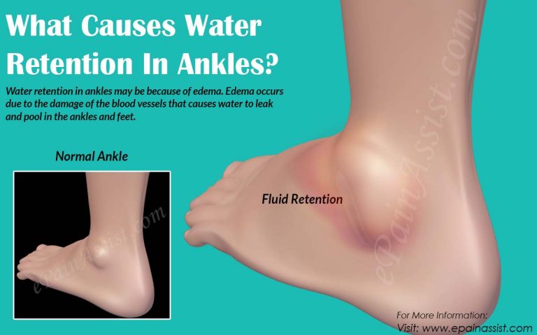 What Causes Water Retention In Ankles?