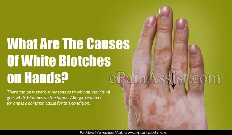 What Causes White Blotches On Hands & Is It Contagious?|Symptoms, Treatments for White Blotches On Hands