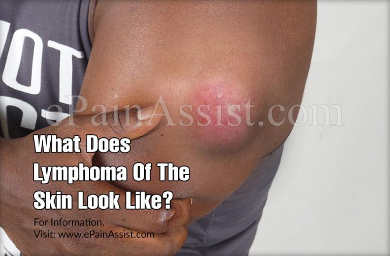 What Does Lymphoma Of The Skin Look Like?