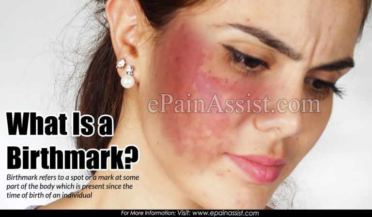 What is a Birthmark, Know its Types, Ways to Get Rid of it?