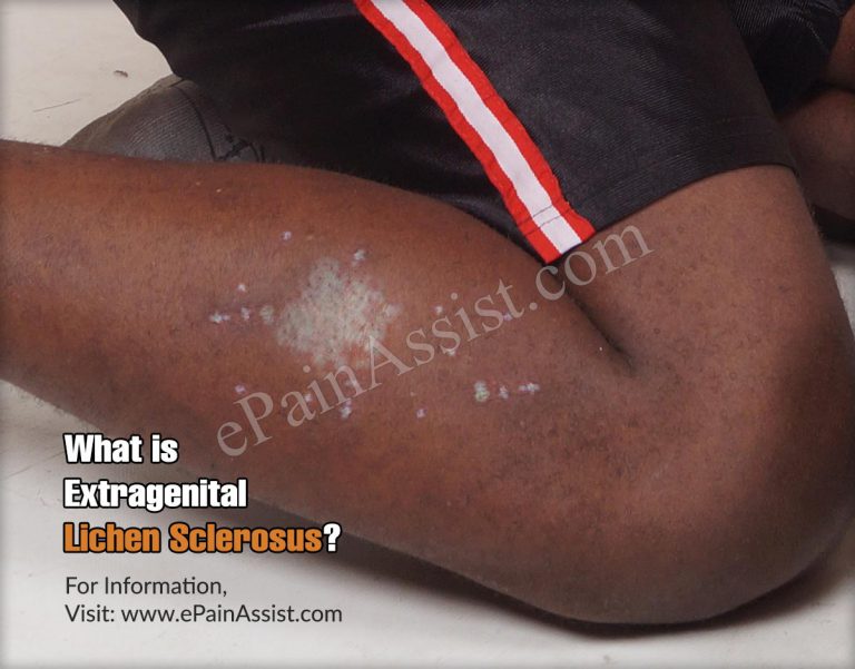 What Is Extragenital Lichen Sclerosus?