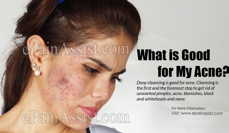 What is Good for My Acne?