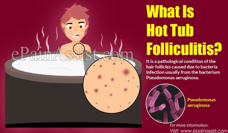 What is Hot Tub Folliculitis: Causes, Symptoms, Treatment, Complications, Prevention, Diagnosis