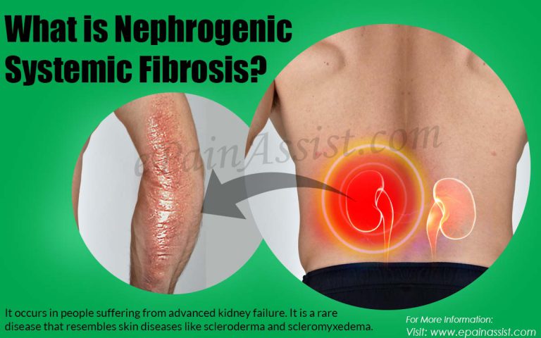 What is Nephrogenic Systemic Fibrosis: Causes, Symptoms, Treatment, Prevention, Diagnosis