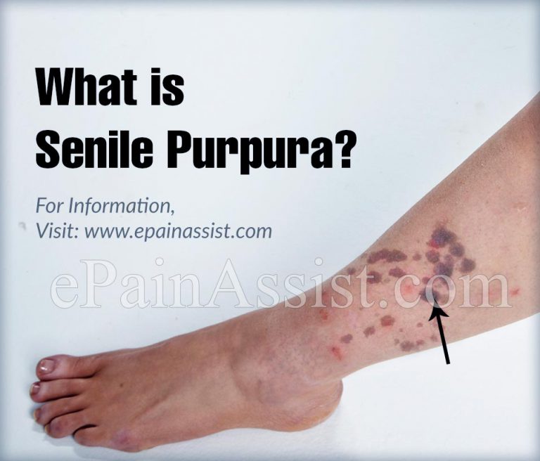 What is Senile Purpura & How is it Treated?|Causes, Symptoms, Natural Remedies for Senile Purpura