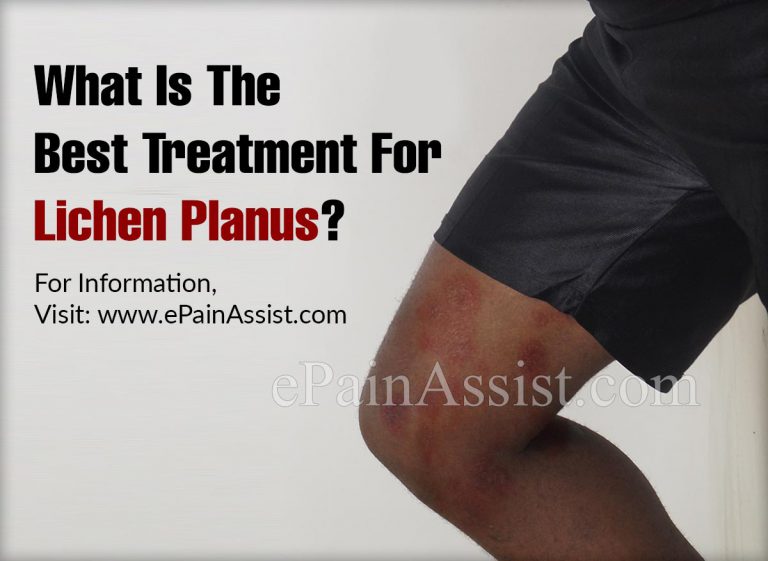What Is The Best Treatment For Lichen Planus?
