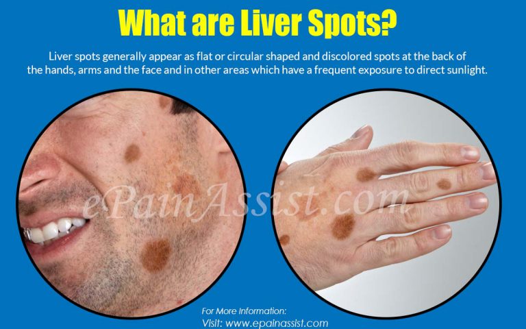 What Causes Liver Spots on Face, Hands, and Skin & How to Get Rid of It?