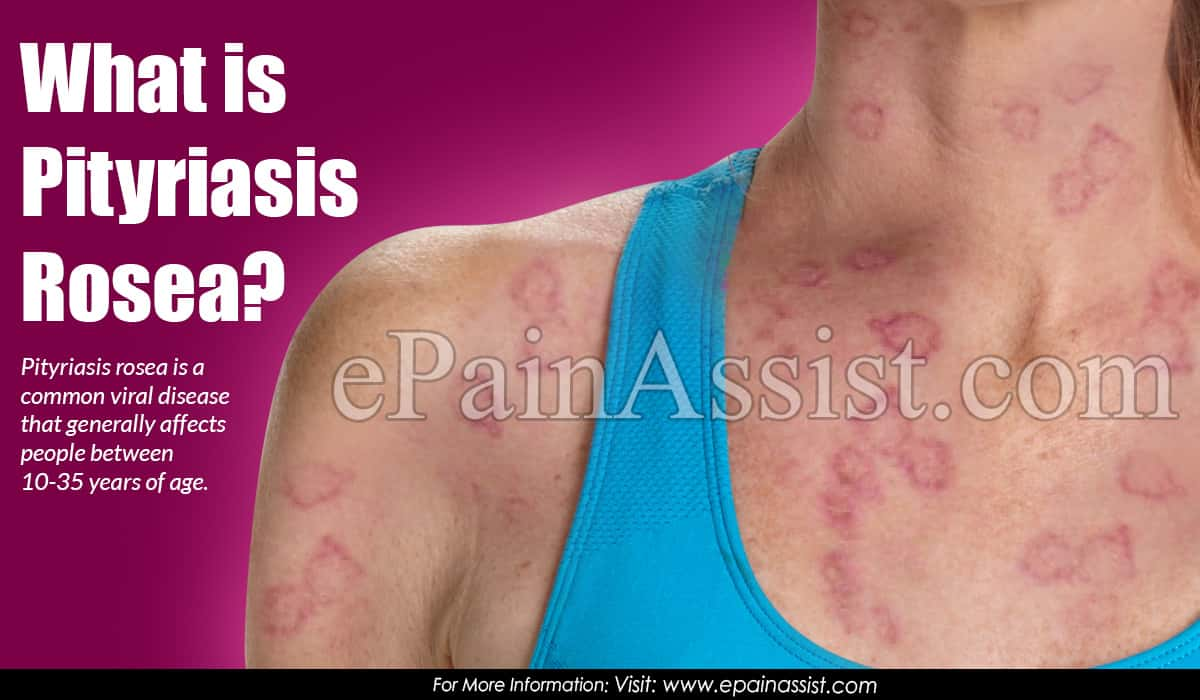 What is Pityriasis Rosea?