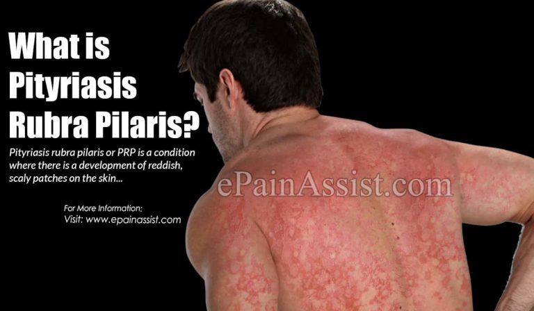 Is Pityriasis Rubra Pilaris Contagious & How is it Treated?|Types, Causes, Symptoms, Stages of Pityriasis Rosea