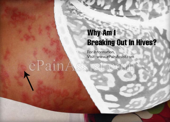 Why Am I Breaking Out In Hives