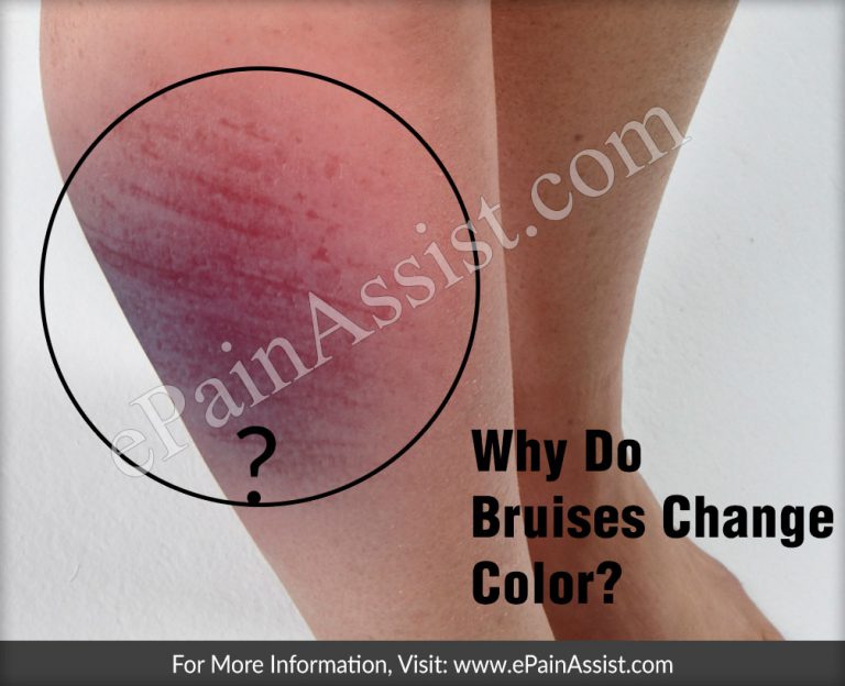 Why Do Bruises Change Color & What Are The Colors They Change To As They Heal?