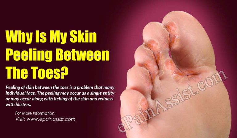 Why Is My Skin Peeling Between The Toes?