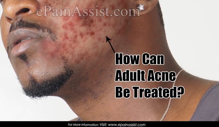 How Can Adult Acne Be Treated?