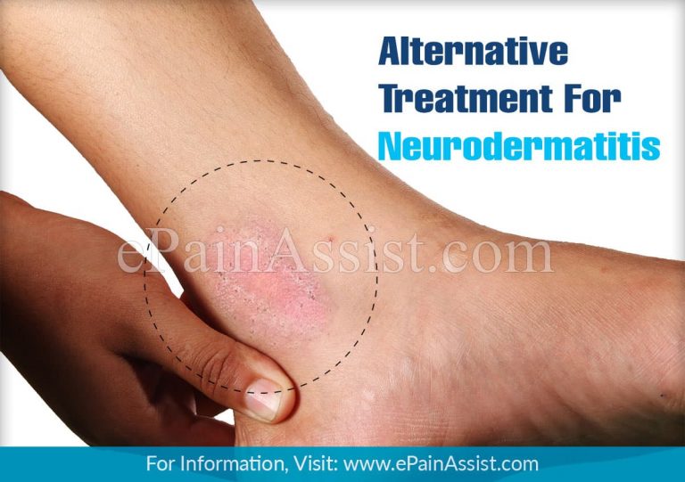 Alternative Treatment For Neurodermatitis