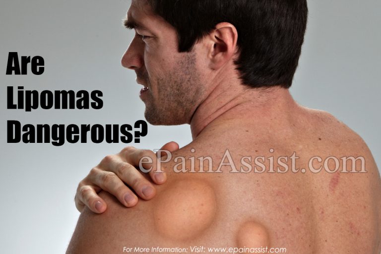 Are Lipomas Dangerous?