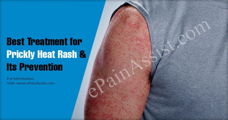 Best Treatment for Prickly Heat Rash & Its Prevention