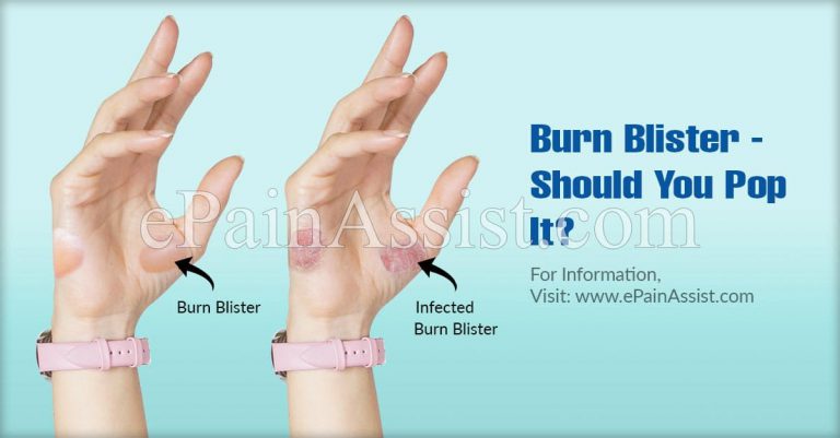 Burn Blister – Should You Pop It?