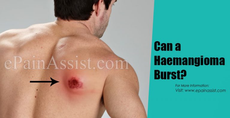 Can a Haemangioma Burst?