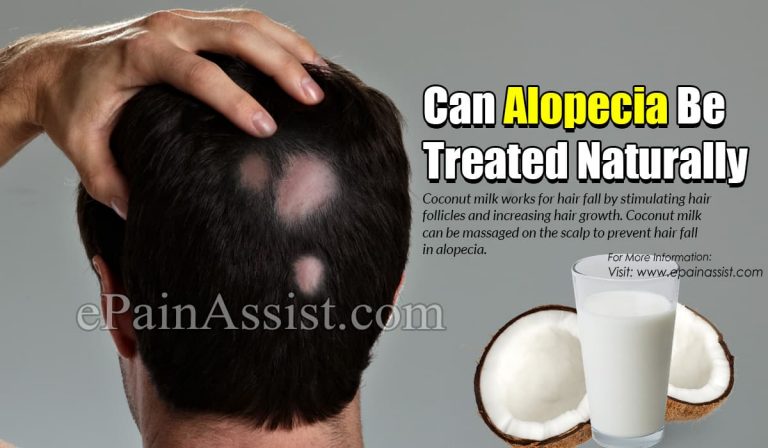 Can Alopecia Be Treated Naturally
