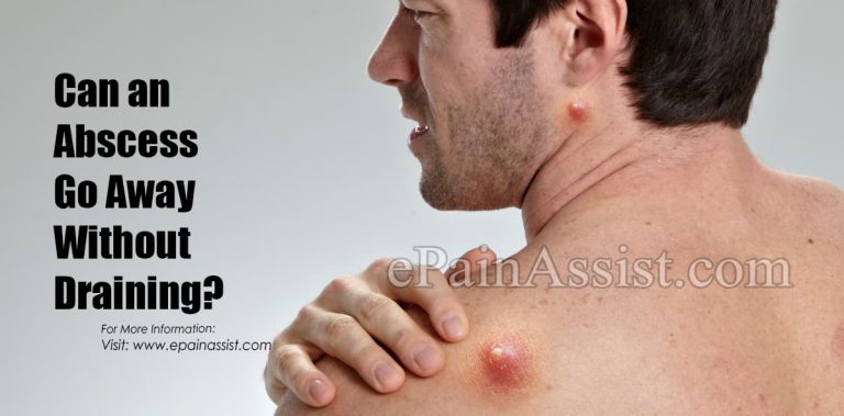Can an Abscess Go Away Without Draining?
