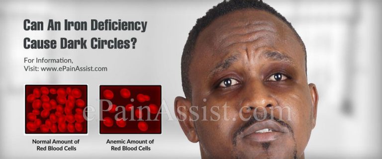 Can An Iron Deficiency Cause Dark Circles Under Eyes & What About Vitamins?