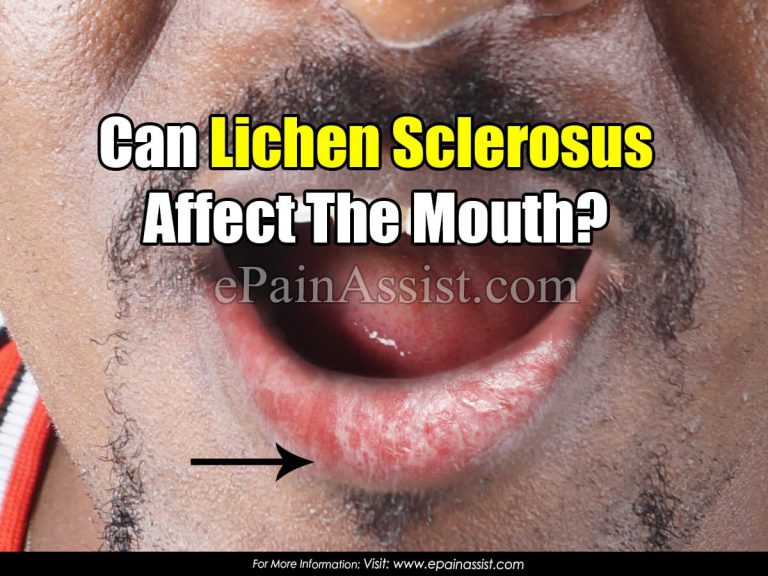 Can Lichen Sclerosus Affect The Mouth?