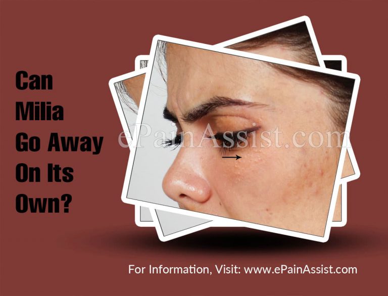 Can Milia Go Away On Its Own?