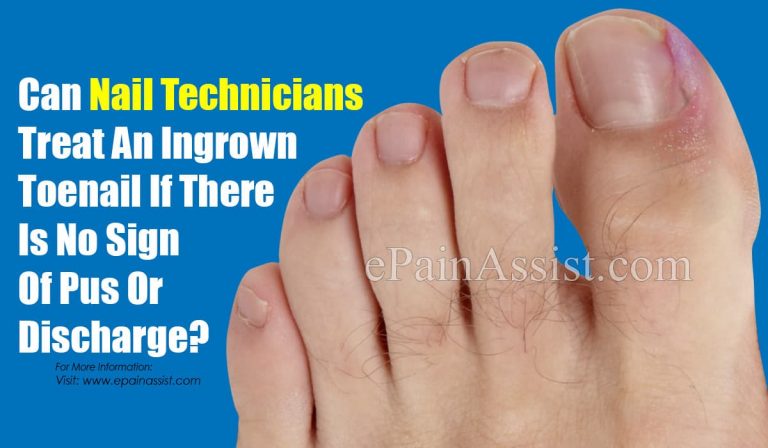 Can Nail Technicians Treat An Ingrown Toenail If There Is No Sign Of Pus Or Discharge?