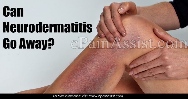 Can Neurodermatitis Go Away?