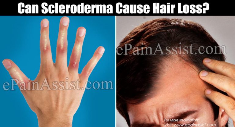 Can Scleroderma Cause Hair Loss?