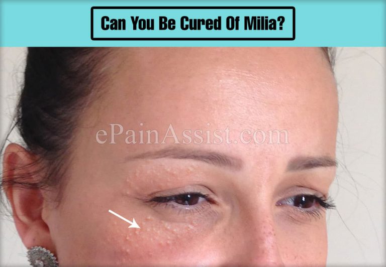 Can You Be Cured Of Milia?