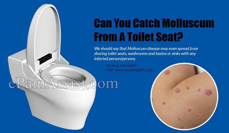 Can You Catch Molluscum From A Toilet Seat?
