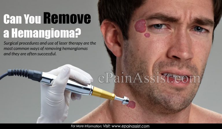 Can You Remove a Hemangioma?
