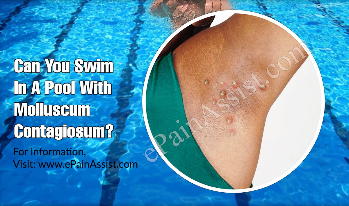 Can You Swim In A Pool With Molluscum Contagiosum?