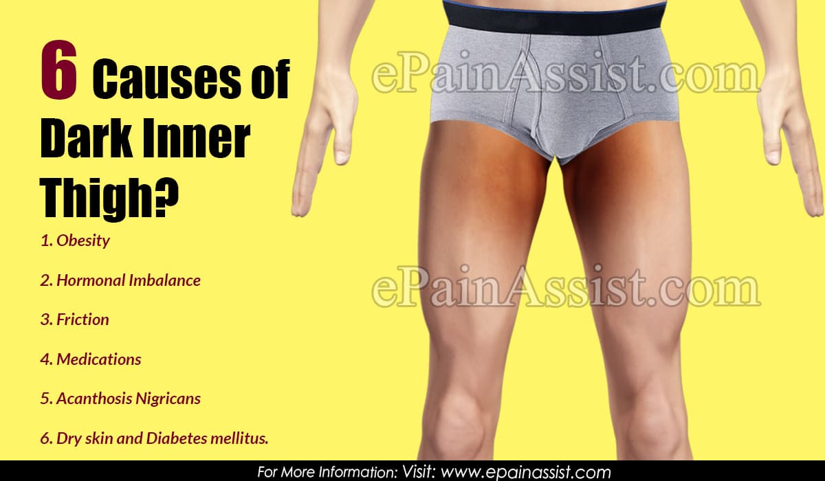 6 Causes of Dark Inner Thigh?