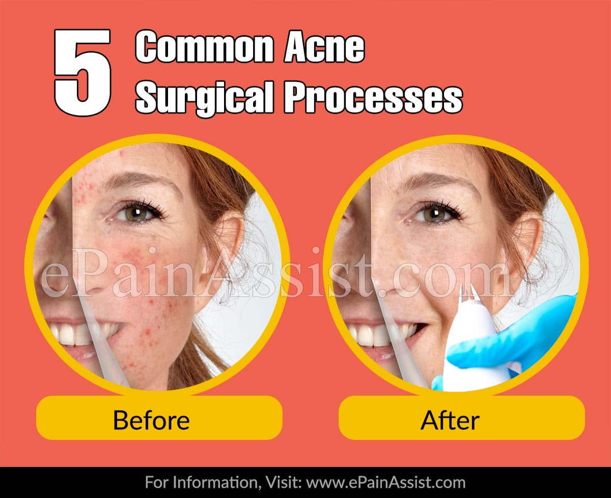 5 Common Acne Surgical Processes