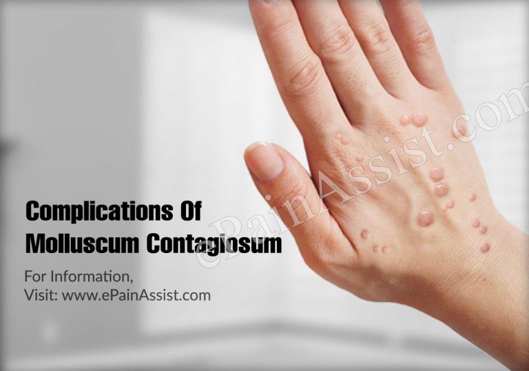Complications Of Molluscum Contagiosum