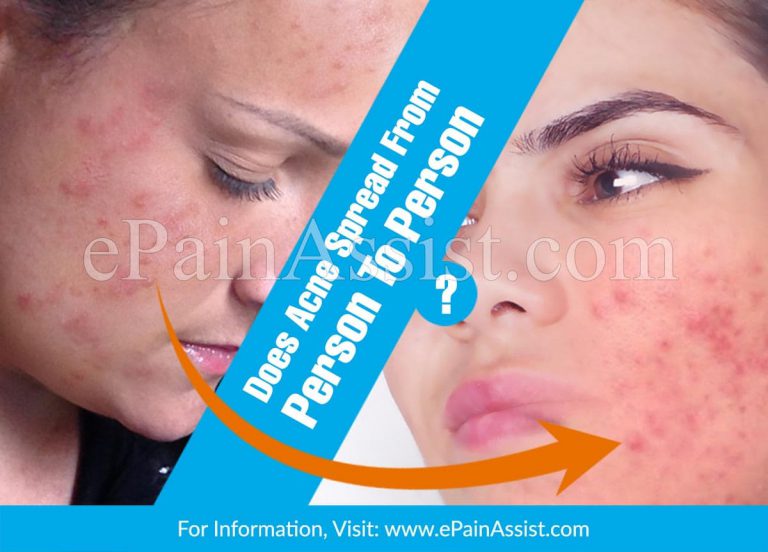 Does Acne Spread From Person To Person?