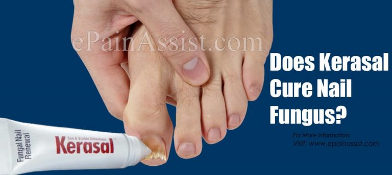 Does Kerasal Cure Nail Fungus?
