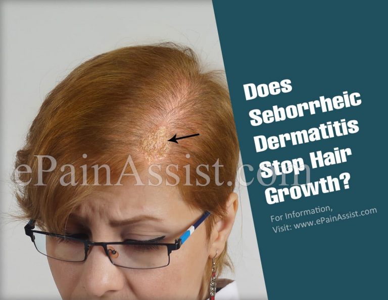 Does Seborrheic Dermatitis Stop Hair Growth?|Should You Wash Your Hair Everyday If You Have Seborrheic Dermatitis?